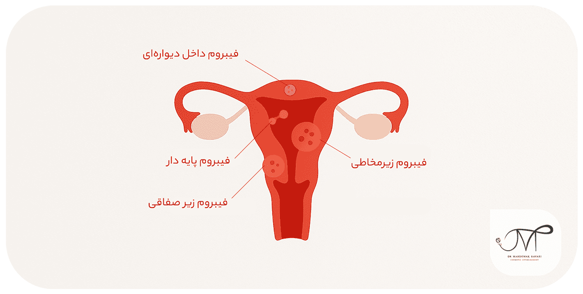 واع فیبروم رحم