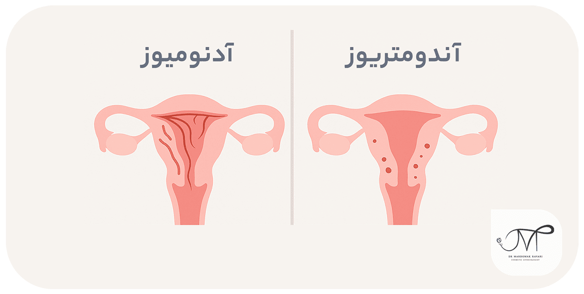 تفاوت آدنومیوز با اندومتریوز