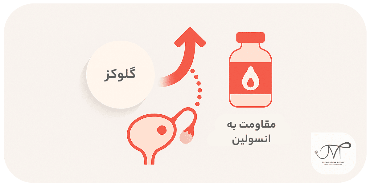 مقاومت به انسولین در PCOS