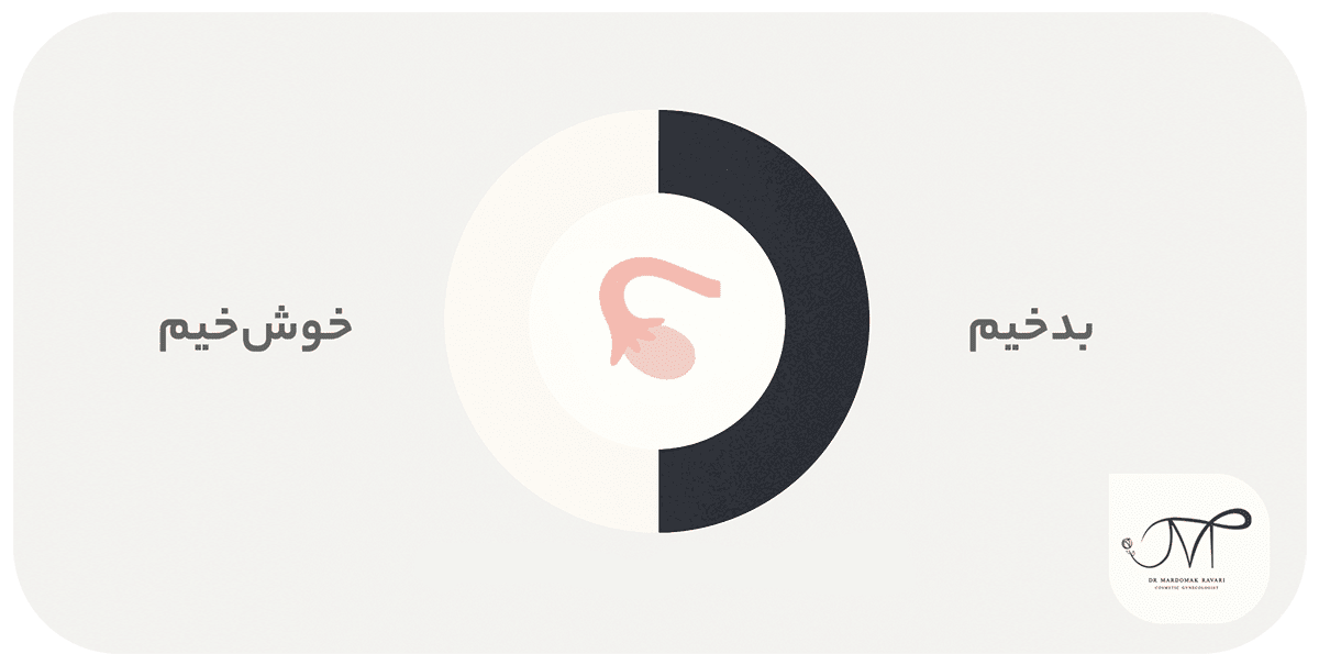 مقایسه نئوپلاسم خوشخیم و بدخیم تخمدان