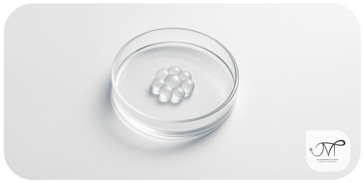 IVF برای ناباروری ناشی از اختلال فاز لوتئال
