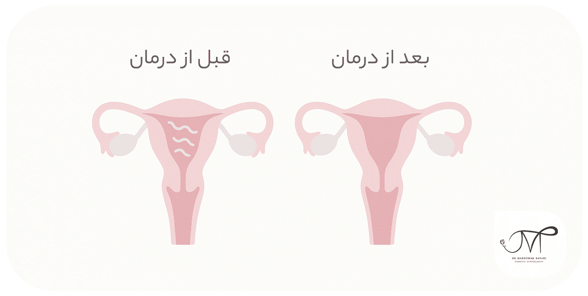 درمان چسبندگی رحم با هیستروسکوپی