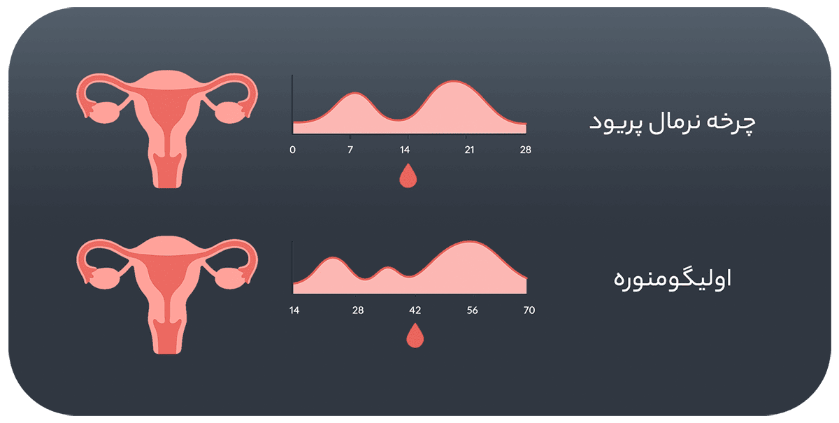 مقایسه چرخه طبیعی قاعدگی با اولیگومنوره