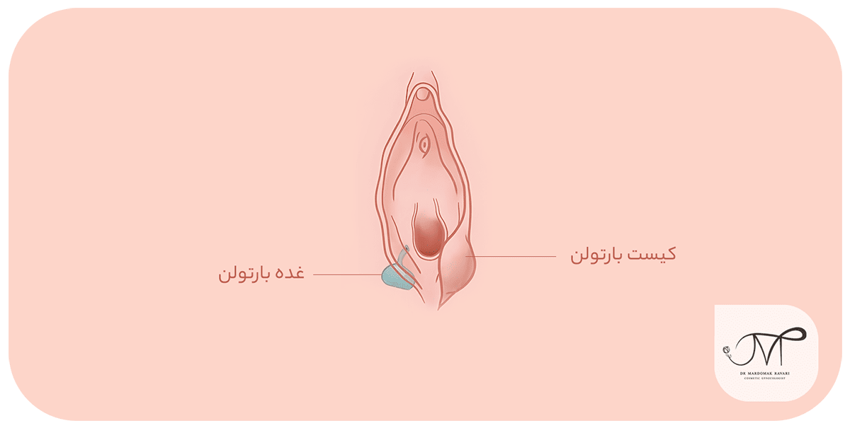 غدد بارتولن در ورودی واژن
