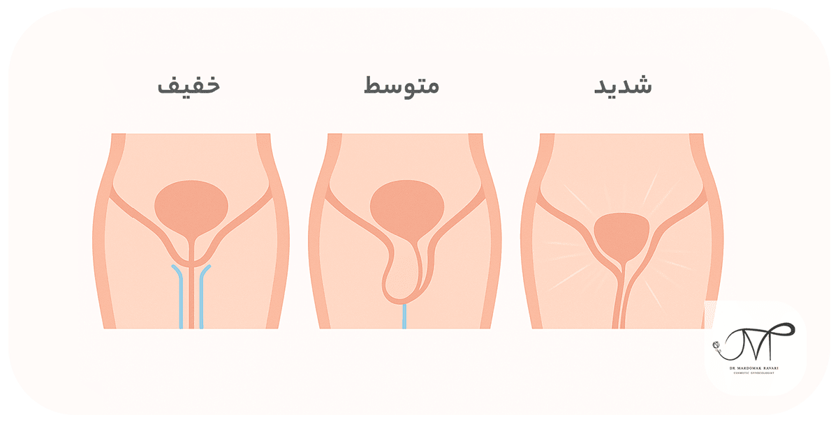 درجات مختلف افتادگی مثانه