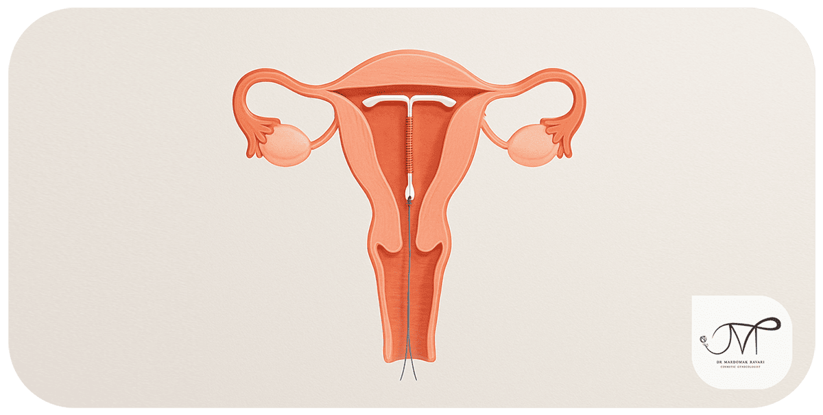 نحوه قرار گرفتن IUD در رحم