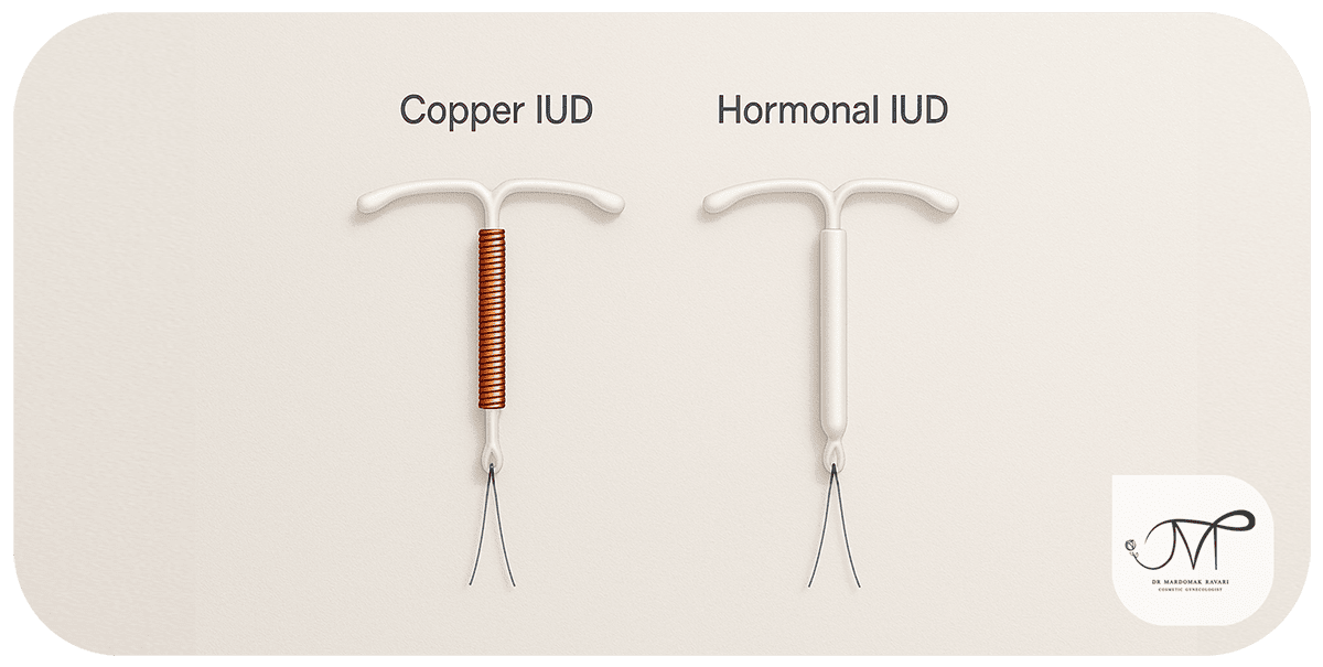 تفاوت IUD مسی و هورمونی