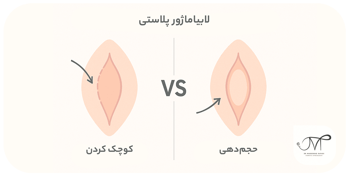 روشهای لابیاماژور پلاستی