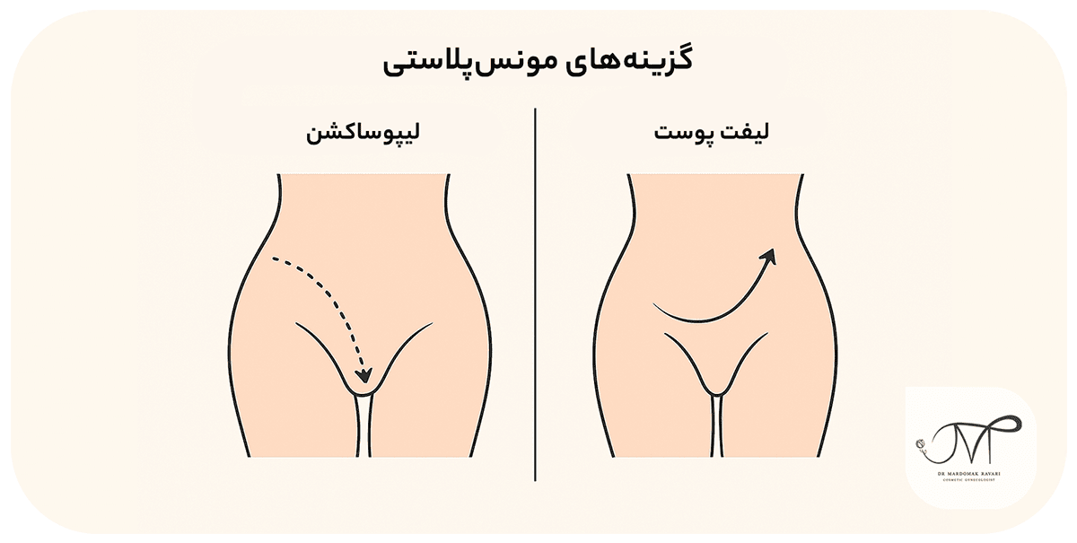 روشهای مونسپلاستی: لیپوساکشن و لیفت پوست