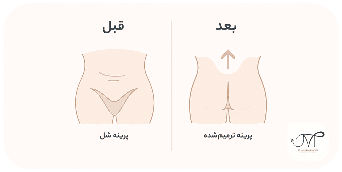 مقایسه پرینه شل و پرینه ترمیمشده با پرینیورافی