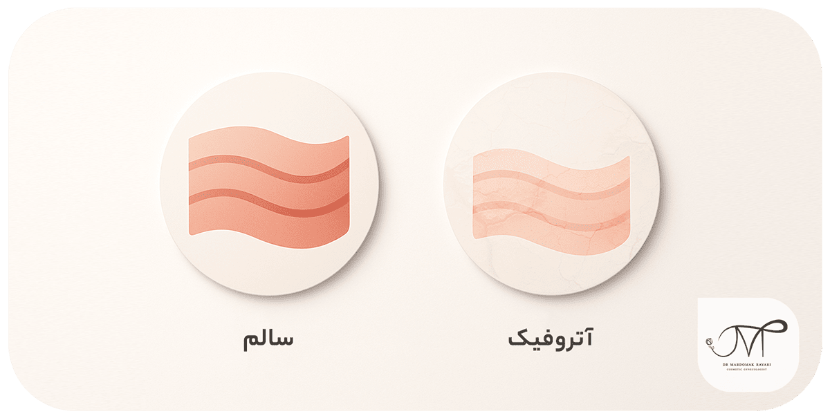 بافت واژن سالم در مقابل آتروفیک