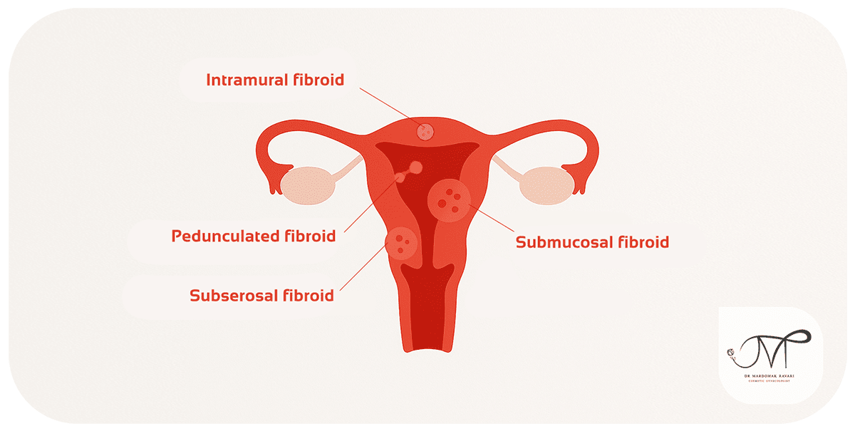 Types of fibroids based on location