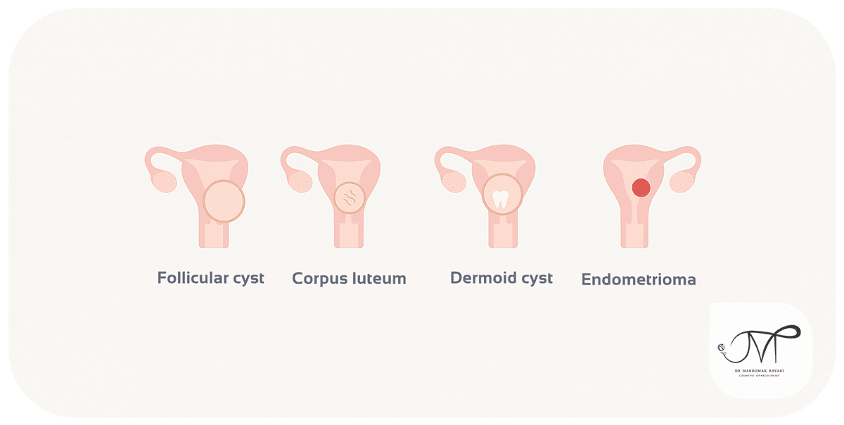 Types of Ovarian Cysts 