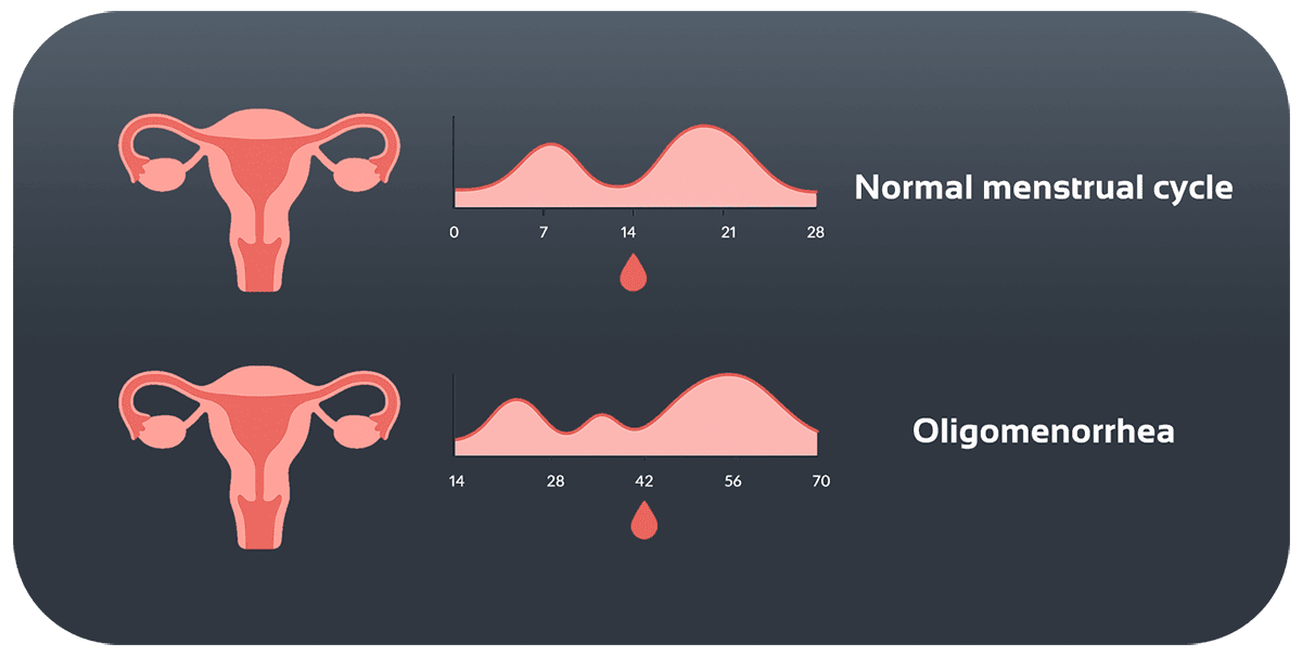 Comparison between normal menstrual cycle and oligomenorrhea