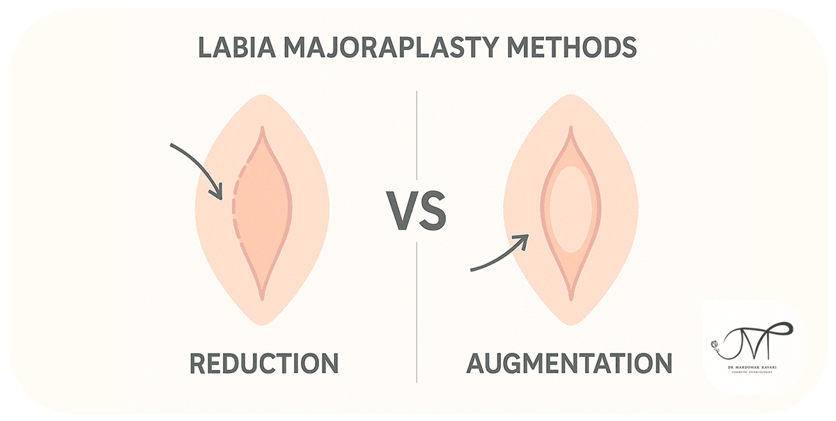 Labia Majora Plasty